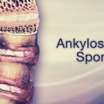 Ankylosing Spondylitis
