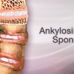 Ankylosing Spondylitis