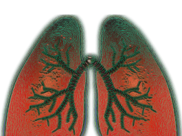 Lung cancer