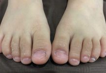 Main Signs and Symptoms of Kawasaki Syndrome