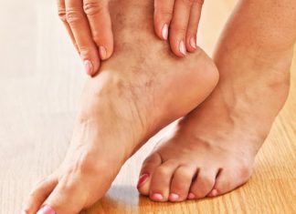 How to Know if You Should Treat Your Varicose Veins